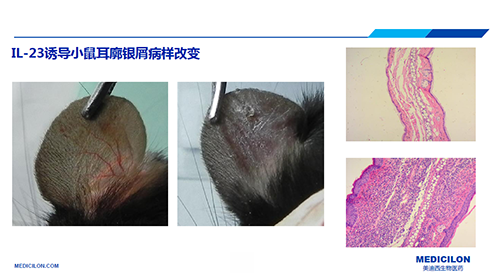 白介素IL-23诱导的小鼠耳廓银屑病样改变