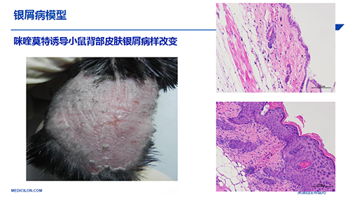 银屑病模型